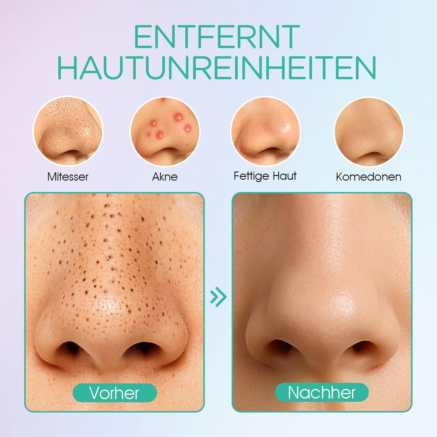 VOYOR Mitesserentferner Porenreiniger Vakuumsauger Nase Akne Pickelsauger