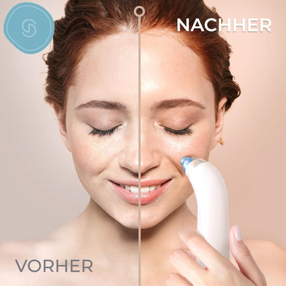 Porenreiniger Vakuumsauger Mitesser Entferner - USB Port 5 Einstellbarer