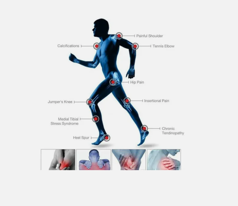 Shockwave Therapy Machine Professionelle Stoßwellentherapie ED Extrakorporale